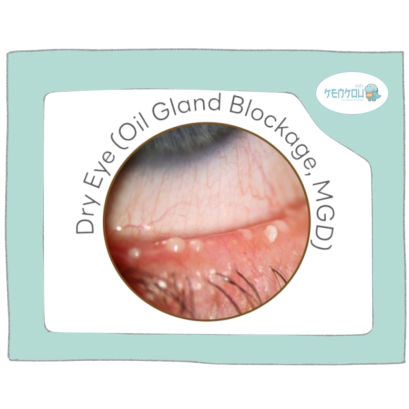 ต่อมไขมันที่เปลือกตาอุดตัน (MGD) คืออะไร? เข้าใจง่ายใน 3 นาที