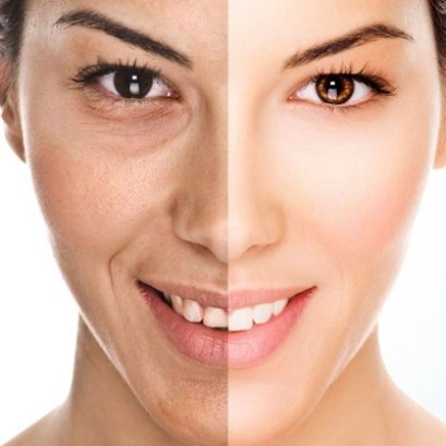 Q-switch เลเซอร์รักษาฝ้า กระ ลบรอยสัก