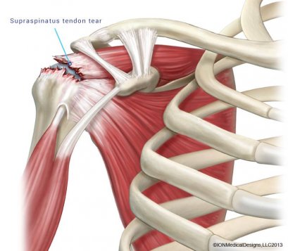เอ็นไหล่ขาด  ( Rotator cuff tear )