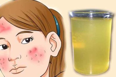 สุดยอดจริงๆ แค่ตื่นขึ้นมาดื่มสิ่งนี้ตอนเช้า สิวก็หายได้อย่างไม่น่าเชื่อ!