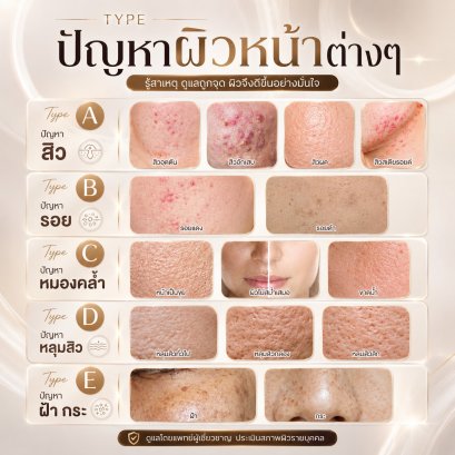 Botox