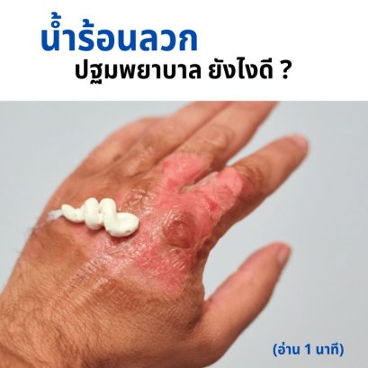 โดนน้ำร้อนลวก ทำยังไงดี?