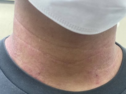 ‘โรคผื่นภูมิแพ้ผิวหนัง’ แพทย์ย้ำไม่ใช่โรคติดต่อ จัดการได้หากรับการรักษาอย่างตรงจุด รักษาเร็วหยุดความเสี่ยงภูมิแพ้ชนิดอื่น ๆ  