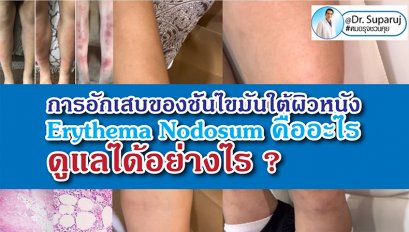 การอักเสบของชั้นไขมันใต้ผิวหนัง Erythema Nodosum คืออะไร ดูแลได้อย่างไร ?