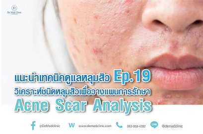 แนะนำเทคนิคดูแลหลุมสิว Ep. 19: วิเคราะห์ชนิดหลุมสิวเพื่อวางแผนการรักษา Acne Scar Analysis