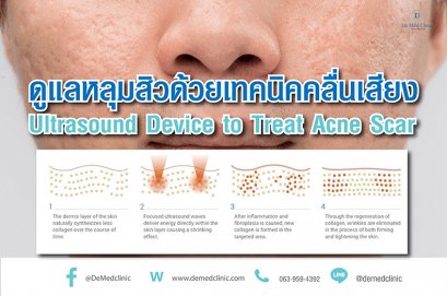 ดูแลหลุมสิวด้วยเทคนิคคลื่นเสียง Ultrasound Device to Treat Acne Scar
