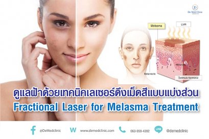 ดูแลฝ้าด้วยเทคนิคเลเซอร์ดึงเม็ดสีแบบแบ่งส่วน Fractional Laser for Melasma Treatment