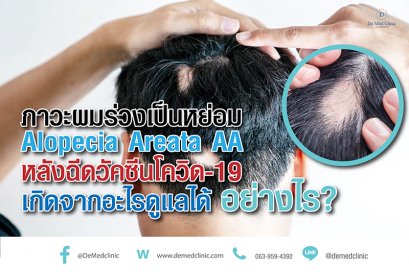 ภาวะผมร่วงเป็นหย่อม Alopecia Areata AA หลังฉีดวัคซีนโควิด-19 เกิดจากอะไรดูแลได้ อย่างไร?
