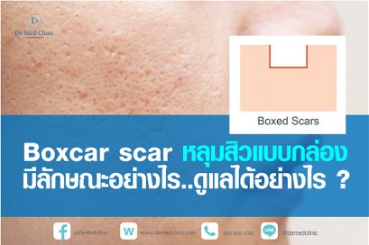 Boxcar scar หลุมสิวแบบกล่อง มีลักษณะอย่างไร ดูแลได้อย่างไร ?
