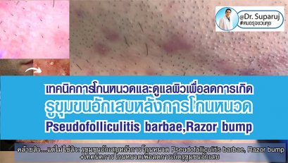 เทคนิคการโกนหนวดและดูแลผิวเพื่อลดการเกิด รูขุมขนอักเสบหลังการโกนหนวด Pseudofolliculitis barbae, Razor bump