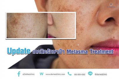 Update เทคนิครักษาฝ้า Melasma Treatment
