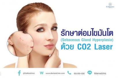 รักษาต่อมไขมันโต (Sebaceous Gland Hyperplasia) ด้วย CO2 Laser