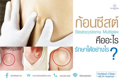 ก้อนซีสต์ Steatocystoma Multiplex คืออะไร รักษาได้อย่างไร ?