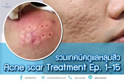 รวมเทคนิคดูแลหลุมสิว Acne scar Treatment Ep. 1-15