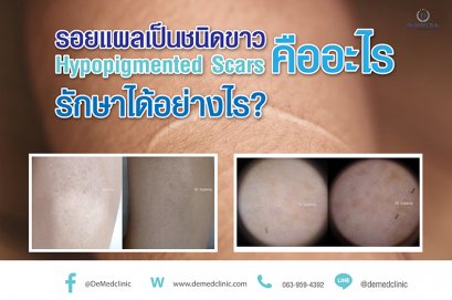 รอยแผลเป็นชนิดขาว Hypopigmented Scars คืออะไร รักษาได้อย่างไร?