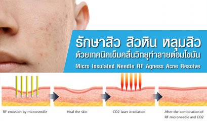 รักษาสิว สิวหิน หลุมสิวด้วยเทคนิคเข็มคลื่นวิทยุทำลายต่อมไขมัน Micro Insulated Needle RF Agness Acne Resolve