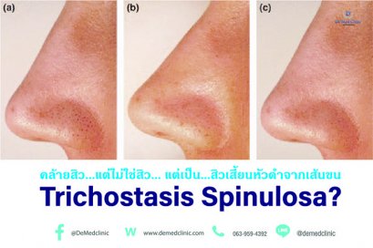 คล้ายสิว…แต่ไม่ใช่สิว… แต่เป็น…สิวเสี้ยนหัวดำจากเส้นขน Trichostasis Spinulosa?