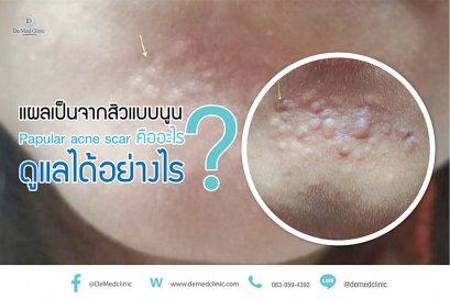 แผลเป็นจากสิวแบบนูน Papular acne scar คืออะไร ? ดูแลได้อย่างไร ?