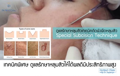 ดูแลรักษาหลุมสิวเทคนิคตัดพังผืดหลุมสิว  Special Subcision Technique 