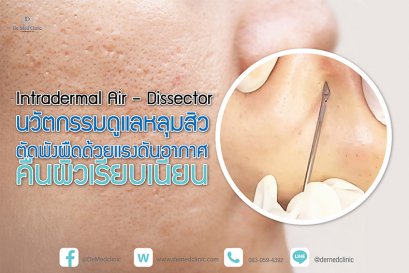 Intradermal Air – Dissector นวัตกรรมดูแลหลุมสิว ตัดพังผืดด้วยแรงดันอากาศ คืนผิวเรียบเนียน