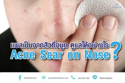 แผลเป็นจากสิวที่จมูก ดูแลได้อย่างไร Acne Scar on Nose ?