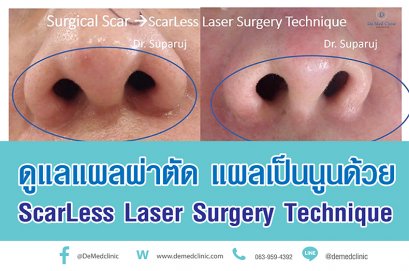 ดูแลแผลผ่าตัด แผลเป็นนูนด้วย ScarLess Laser Surgery Technique