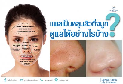 แผลเป็นหลุมสิวที่จมูก ดูแลได้อย่างไรบ้าง ?