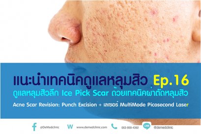 แนะนำเทคนิคดูแลหลุมสิว ep. 16 ดูแลหลุมสิวลึก Ice Pick Scar ด้วยเทคนิคผ่าตัดหลุมสิว Acne Scar Revision: Punch Excision + เลเซอร์ MultiMode Picosecond Laser