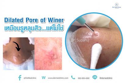 Dilated Pore of Winer เหมือนรูหลุมสิว...แต่ไม่ใช่
