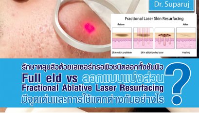 รักษาหลุมสิวด้วยเลเซอร์กรอผิวชนิดลอกทั้งช้ันผิว Full field vs ลอกแบบแบ่งส่วน Fractional Ablative Laser Resurfacing มีจุดเด่นและการใช้แตกต่างกันอย่างไร ?