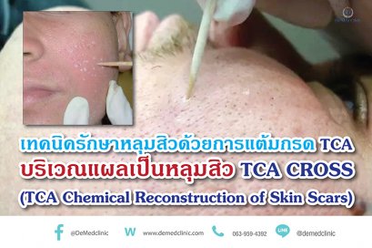 เทคนิครักษาหลุมสิวด้วยการแต้มกรด TCA บริเวณแผลเป็นหลุมสิว TCA CROSS (TCA Chemical Reconstruction of Skin Scars)