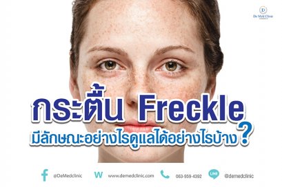 กระตื้น Freckle มีลักษณะอย่างไรดูแลได้อย่างไรบ้าง?