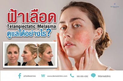 ฝ้าเลือด Telangiectatic Melasma ดูแลได้อย่างไร?