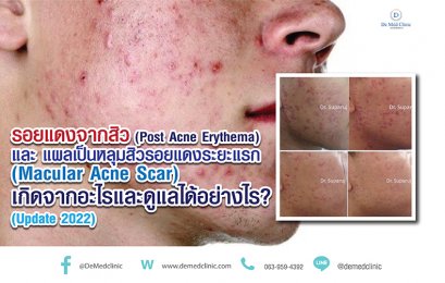 รอยแดงจากสิว (Post Acne Erythema) และ แผลเป็นหลุมสิวรอยแดงระยะแรก (Macular Acne Scar) เกิดจากอะไรและดูแลได้อย่างไร? (Update 2022)