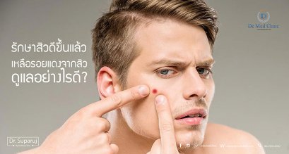 รักษาสิวดีขึ้นแล้ว เหลือรอยแดงจากสิว ดูแลอย่างไรดี?