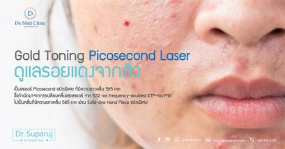 Gold Toning Picosecond Laser ดูแลรอยแดงจากสิว