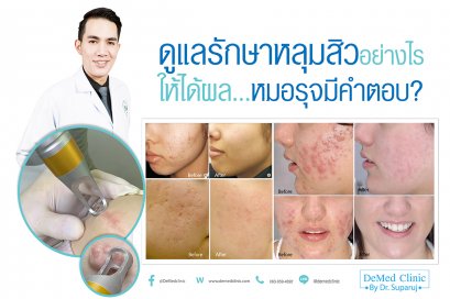 ดูแลรักษาหลุมสิวอย่างไรให้ได้ผล...หมอรุจมีคำตอบ?