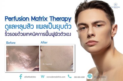 Perfusion Matrix Therapy ดูแลหลุมสิว แผลเป็นยุบตัว ริ้วรอยด้วยเทคนิคการฟื้นฟูจากภายในผิวตัวเอง