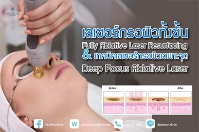 เลเซอร์กรอผิวทั้งชั้น Fully Ablative Laser Resurfacing &เทคนิคเลเซอร์กรอผิวเฉพาะจุด Deep Focus Ablative Laser