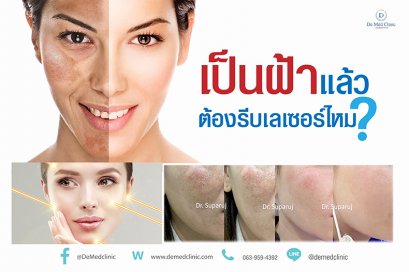 เป็นฝ้าแล้วต้องรีบเลเซอร์ไหม?