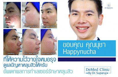 ขอบคุณ คุณนุชา happynucha ที่ให้ความไว้วางใจหมอรุจ ดูแลปัญหาหลุมสิวให้ครับ / อัพเดทผลการทำเลเซอร์รักษาหลุมสิว /