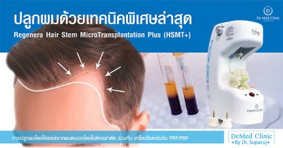 ปลูกผมด้วยเทคนิคพิเศษล่าสุด Regenera Hair Stem MicroTransplantation Plus (HSMT+)