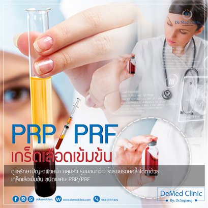 นวัตกรรมการฉีดเกล็ดเลือดเพื่อปลูกผมหรือ PRP or Platelet Rich Plasma (พลาสมาที่มีเกล็ดเลือดเข้มข้น) 