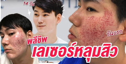 หมอสรุปเป็นเหมือนบทความรีวิวการดูแลรักษาและเป็นและหลุมสิวแต่ละประเภทมาตามในลิงค์นี้ครับ