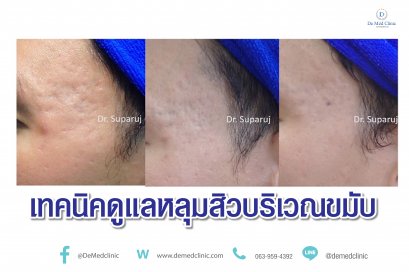 เทคนิคดูแลหลุมสิวบริเวณขมับ !!