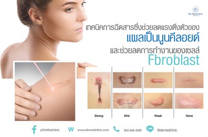 เทคนิคการฉีดสารซึ่งช่วยลดแรงตึงตัวของแผลเป็นนูนคีลอยด์และช่วยลดการทำงานของเซลล์ Fibroblast