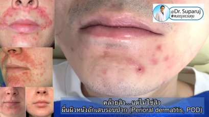 คล้ายสิว…แต่ไม่ใช่สิว… …ผื่นผิวหนังอักเสบรอบปาก (Perioral dermatitis, POD)