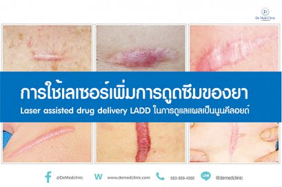 การใช้เลเซอร์เพิ่มการดูดซึมของยา Laser assisted drug delivery LADD ในการดูแลแผลเป็นนูนคีลอยด์