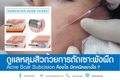ดูแลหลุมสิวด้วยการตัดเซาะพังผืด Acne Scar Subcision คืออะไร มีเทคนิคอย่างไร ?
