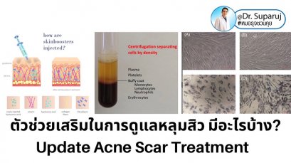 Update ตัวช่วยเสริมในการรักษาหลุมสิว มีอะไรบ้าง?